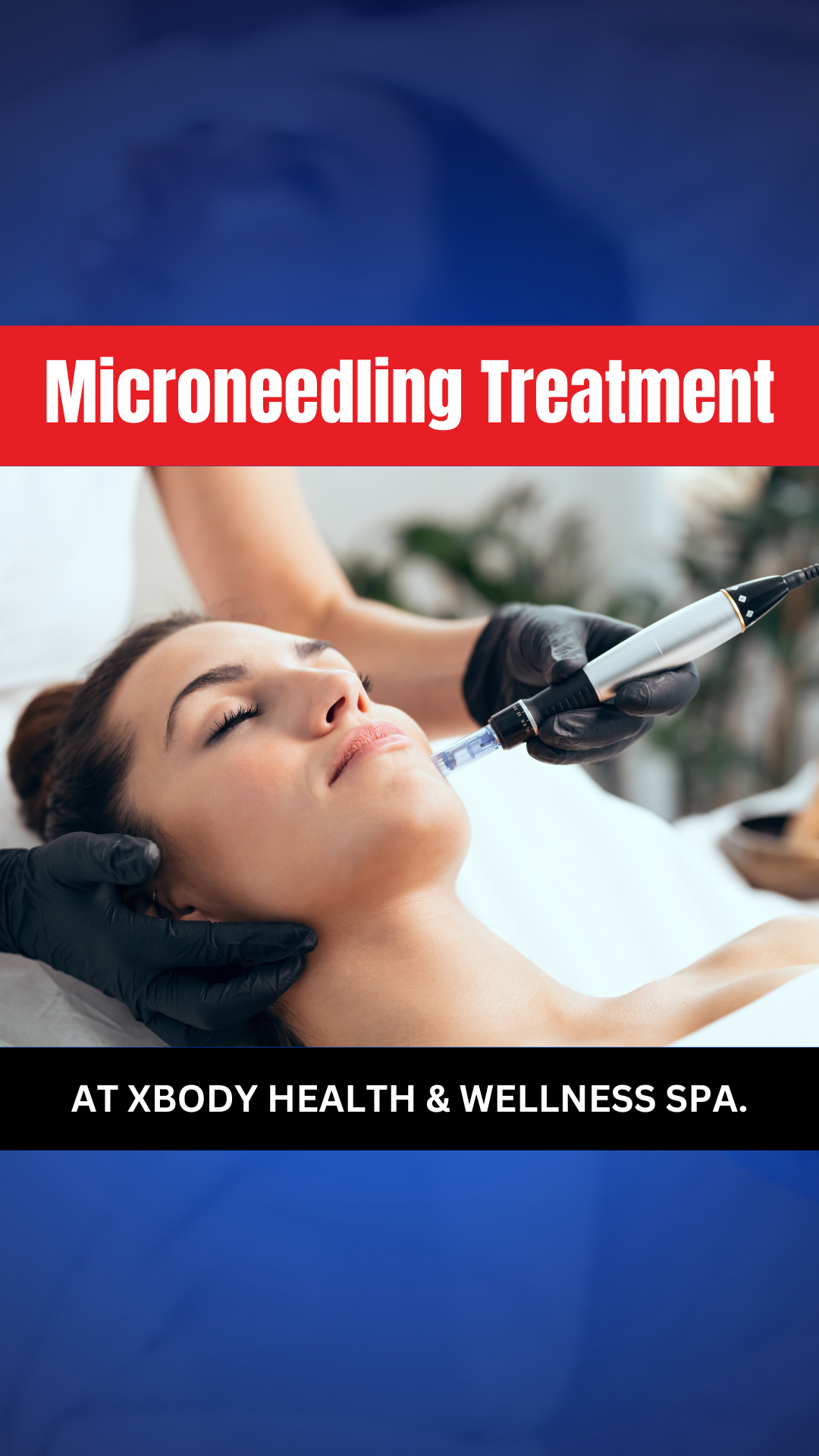 Social Media Management 80 Microneedling Treatment at Xbody Health Wellness Spa. Thumbnail 1080 x 1920